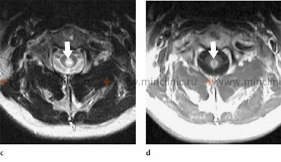 MRI of the cervical spinal cord in infectious myelitis: c - the axial T2-weighted image shows that the lesion of the spinal cord occupies its central part; d - enhancement of the pattern of the spinal cord lesion on the axial T1-weighted image after the administration of the contrast medium.